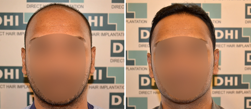 DHI before & after hair transplant results